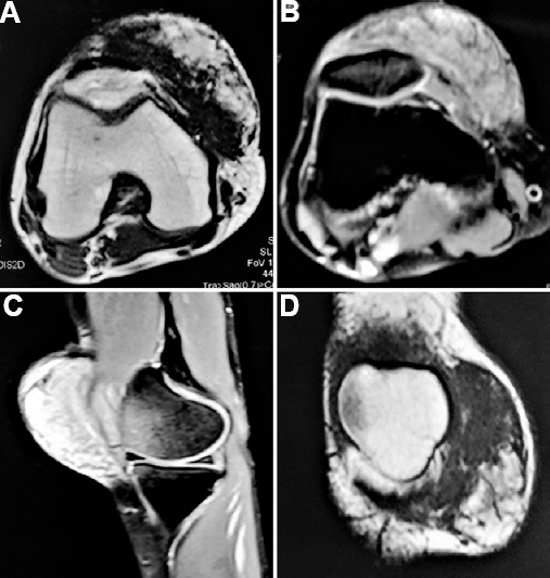 The axial (A) T1-weighted and (B) T2-weighted magnetic resonance images showing the presence of mass overlying patella, more on the medial aspect, with calcified matrix and intact patellar anatomy. (C) Sagital images on the medial aspect of the knee showing the mass and (D) coronal magnetic resonance images delineating the lesion as a mass with heterogeneous calcified matrix.